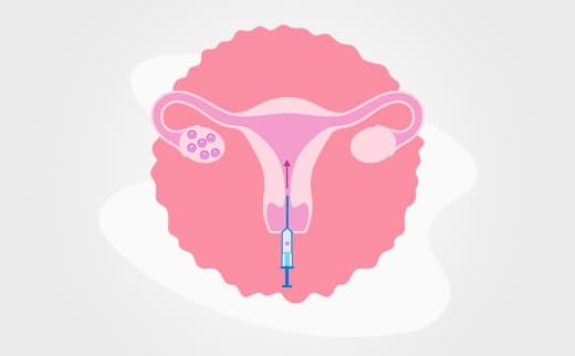 Frozen Embryo Transfer