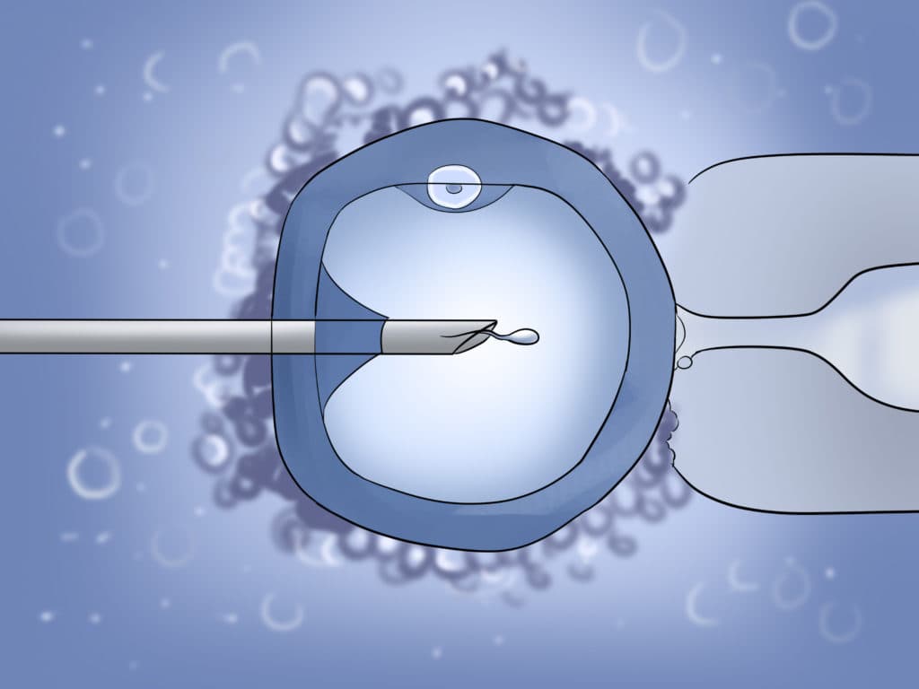 Intracytoplasmic Sperm Injection