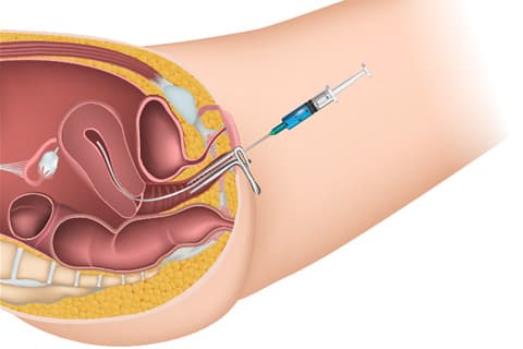 Intrauterine Insemination
