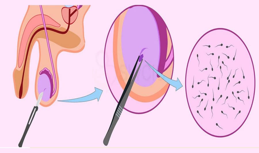 Percutaneous Epididymal Sperm Aspiration