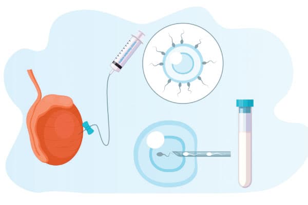 TESA Fertility Treatment